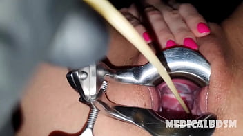 Preview 3 of Tube Nuse - Catheter in cervix insemination sounding