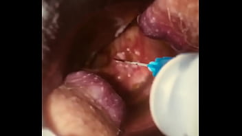 Preview 2 of Sssssxx - Rectal wall injection