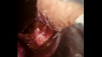 Preview 1 of Sssssxx - Rectal wall injection