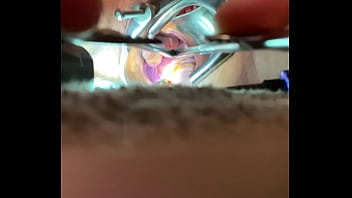 Preview 1 of Hagi Azura - Internal view of Orgasm w sound tenaculum and vibrator