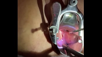 Preview 1 of M Hx Fyw - Insertion of sound tenaculum into cervix