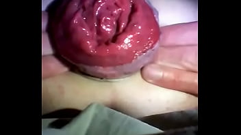 Preview 1 of Sun Lya - Anal prolapse