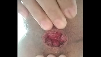 Preview 1 of Billy Bail - Anal prolapse 2