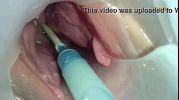 Preview 2 of Casuak Small - Sperm injected into the uterus of the wife of others