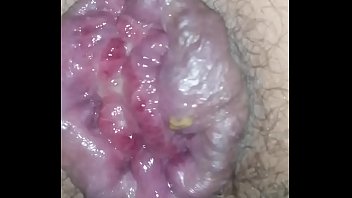 Preview 3 of Lndien Girl - Anal prolapse
