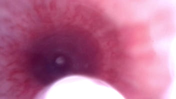Preview 2 of Pornos Mixico - urethra fiber scope