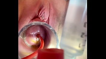 Preview 2 of Me U Ur Mom Xxxx Sxs - w 4cc inflation of catheter balloon inside cervix