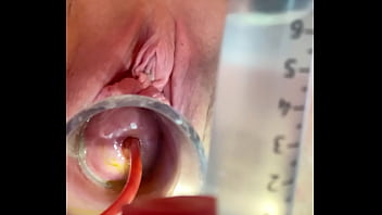 Preview 3 of Me U Ur Mom Xxxx Sxs - w 4cc inflation of catheter balloon inside cervix