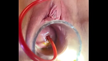 Preview 1 of Me U Ur Mom Xxxx Sxs - w 4cc inflation of catheter balloon inside cervix