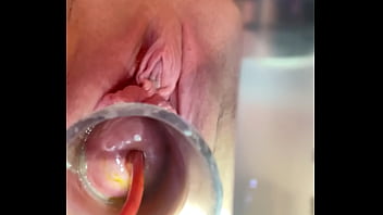 Preview 4 of Me U Ur Mom Xxxx Sxs - w 4cc inflation of catheter balloon inside cervix